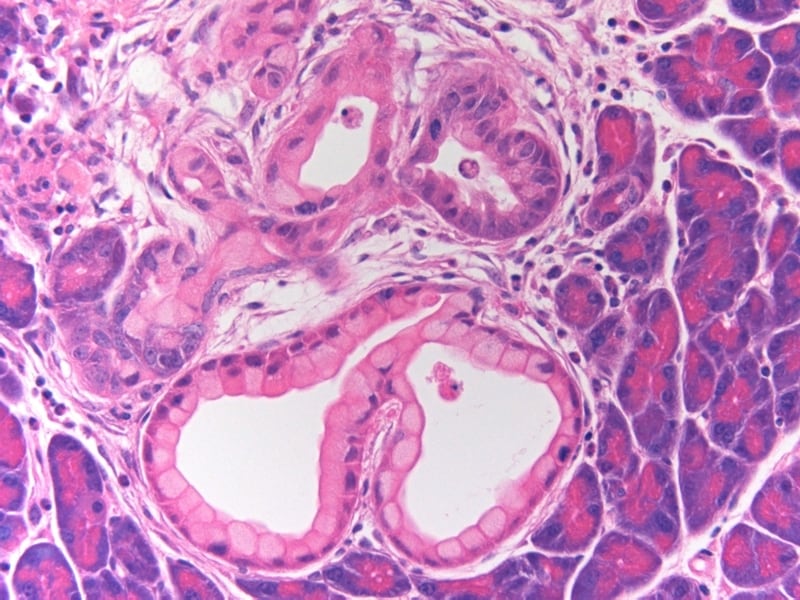 Seen here are two clusters of precancerous cells (lower half of image), which arose in pancreatic cells expressing the cancer gene KRAS.